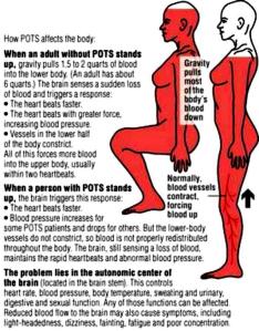 How POTS affects the body. 