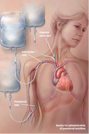 Roures of Parenteral Nutrition